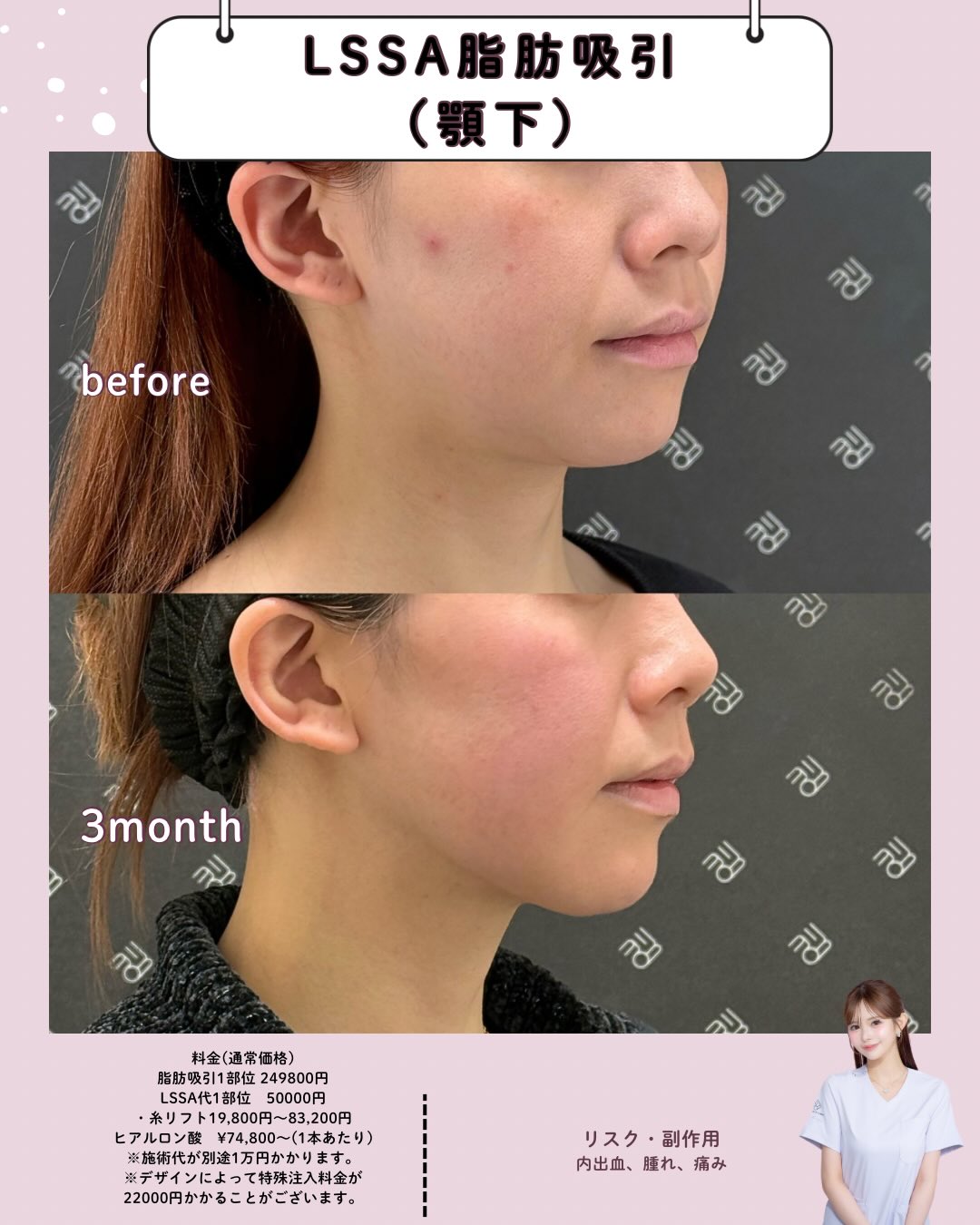 submandibular suction