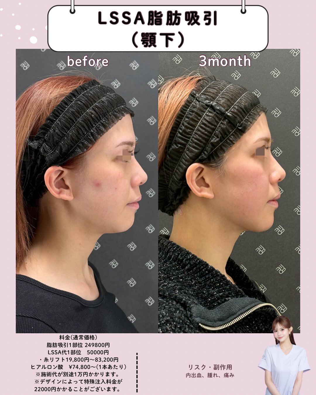 submandibular suction