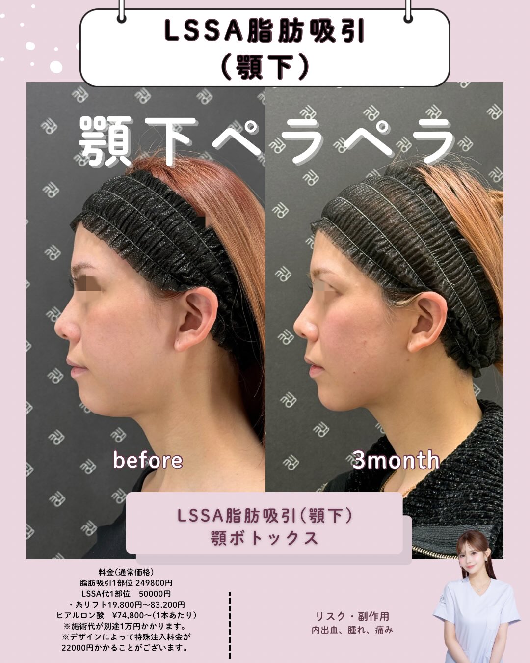 submandibular suction