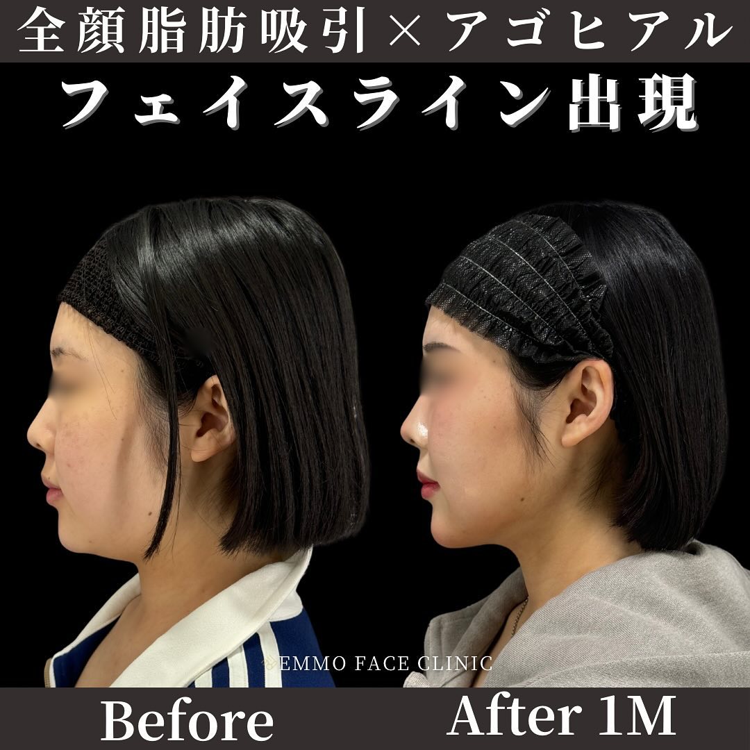 全顔脂肪吸引×ヒアルロン酸