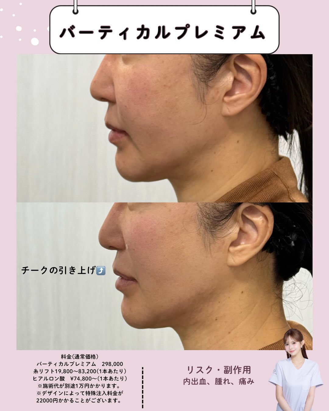 バーティカルリフトプレミアム