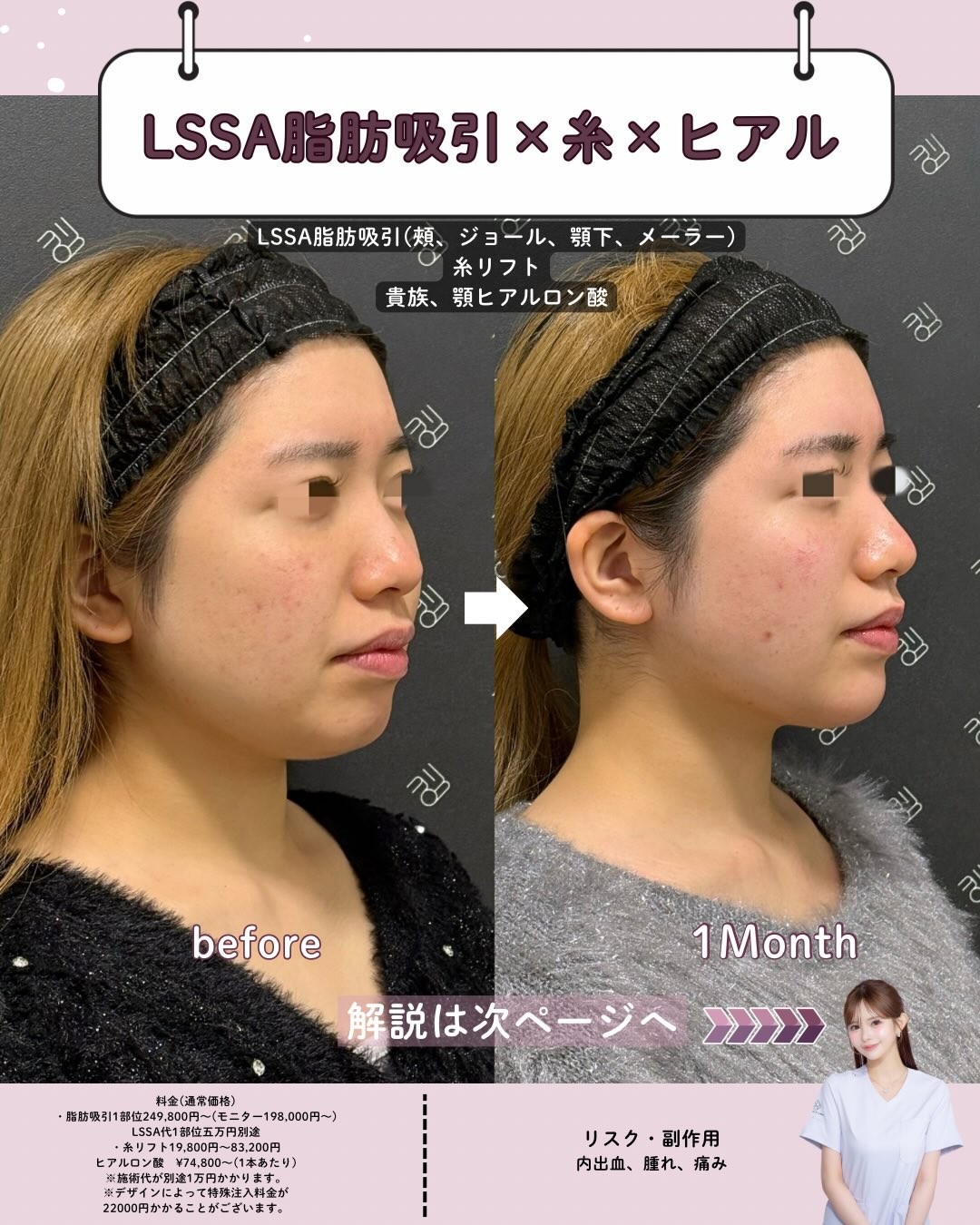 エルサ脂肪吸引+糸リフト+ヒアルロン酸のビフォーアフター