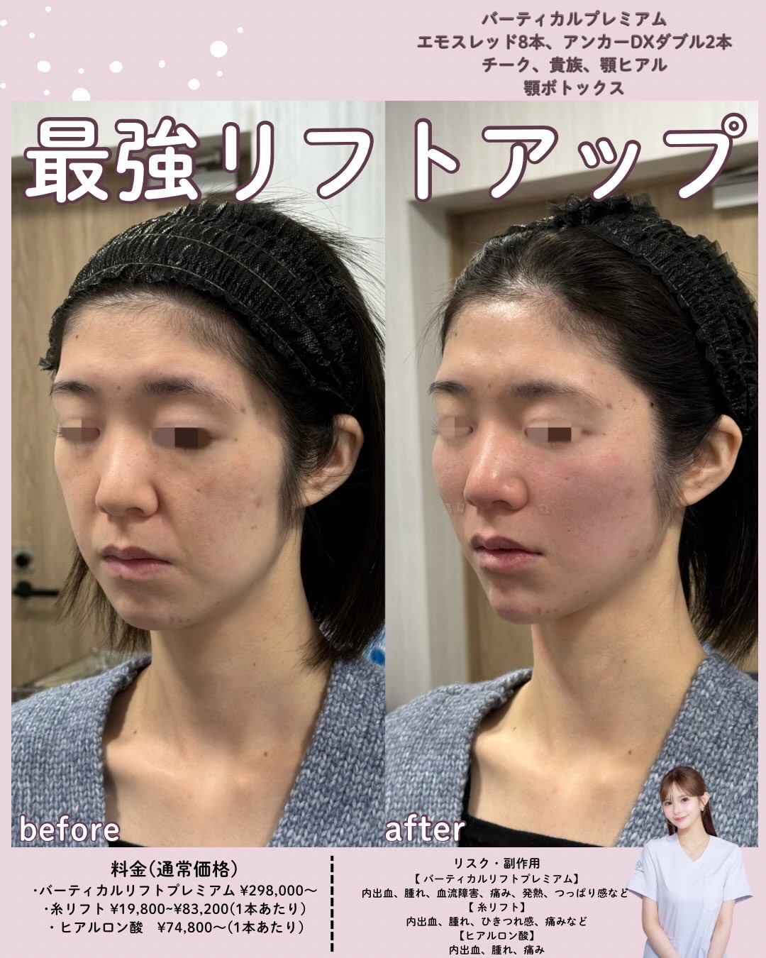 糸リフト+ヒアルロン酸+ボトックス併用のビフォーアフター