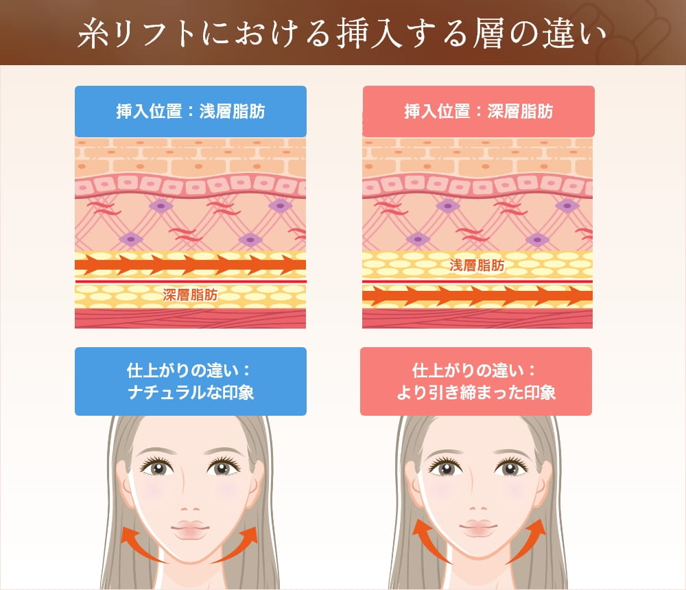 糸リフト挿入層の違いによる仕上がりの比較