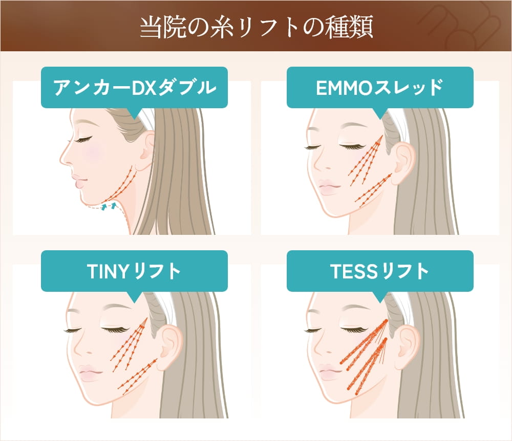 糸リフトの種類と施術範囲を示す4つの顔のイラスト