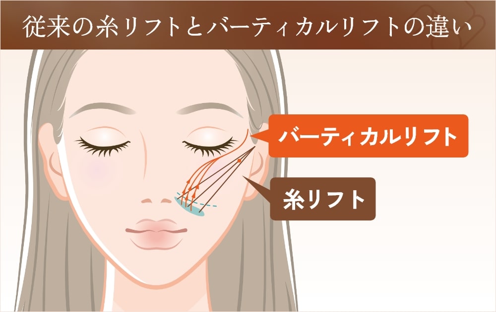 糸リフトとバーティカルリフトの挿入位置を比較するイラスト