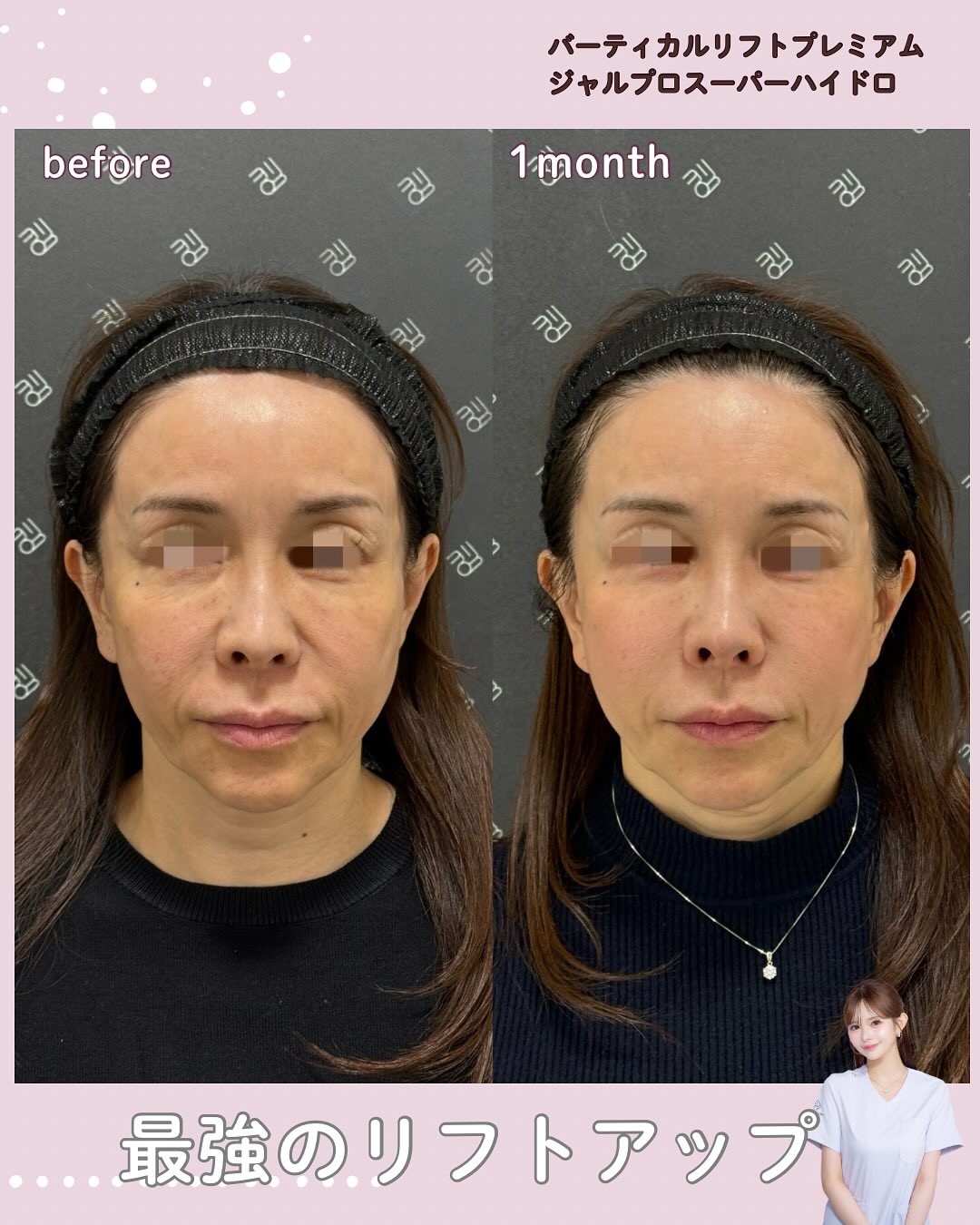 バーティカルリフトプレミアムのビフォーアフター