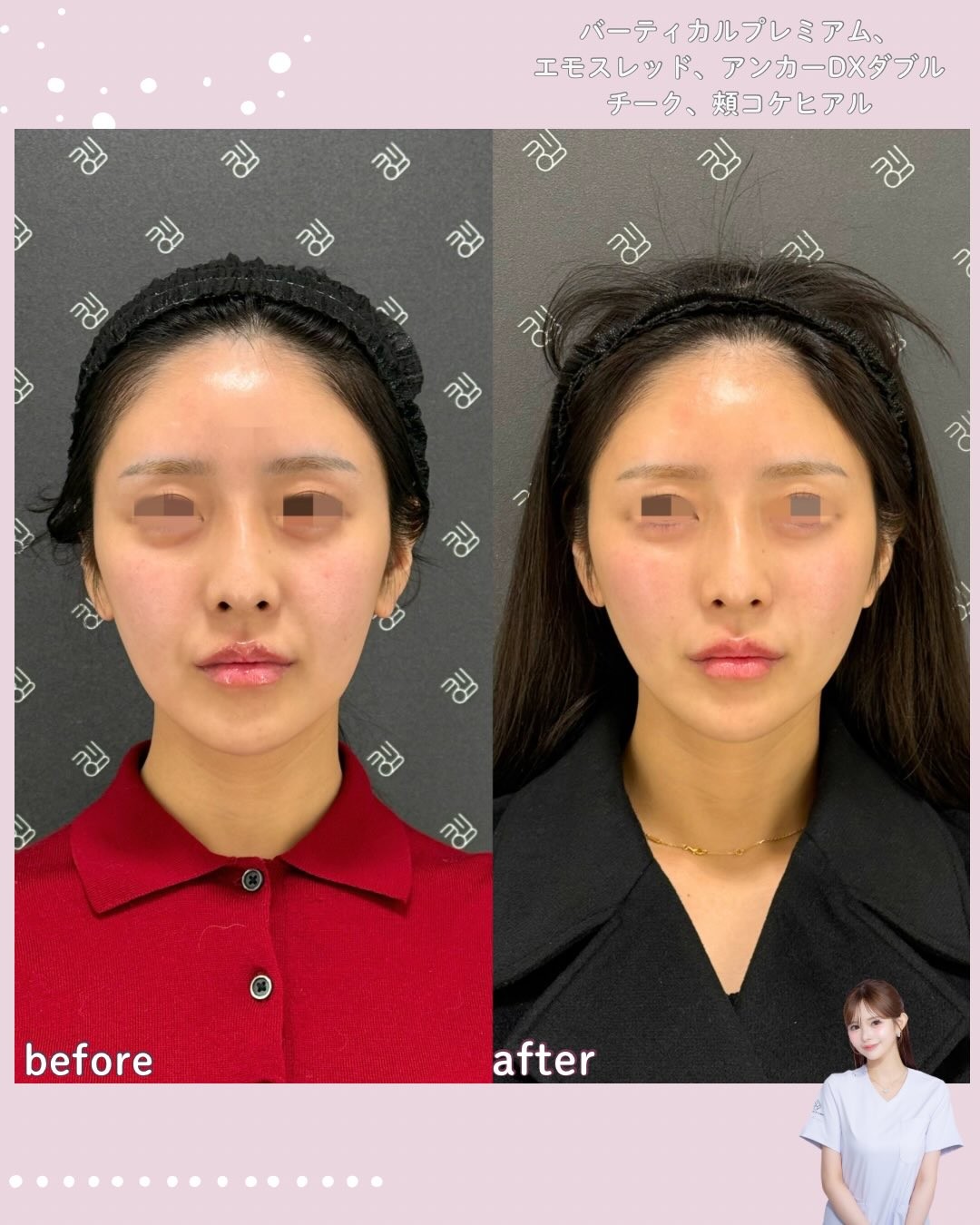 バーティカルリフトプレミアム+糸リフト+ヒアルロン酸フィラーのビフォーアフター