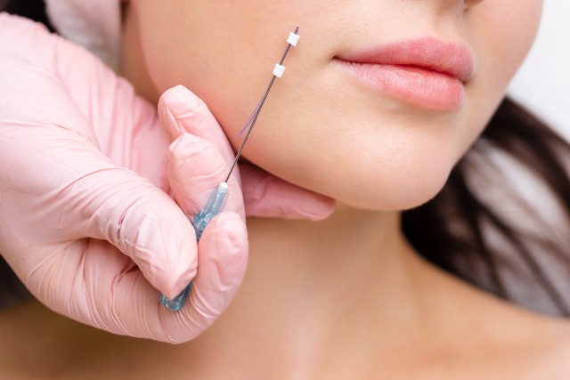 糸リフトの施術を受ける女性の顔と医療用具