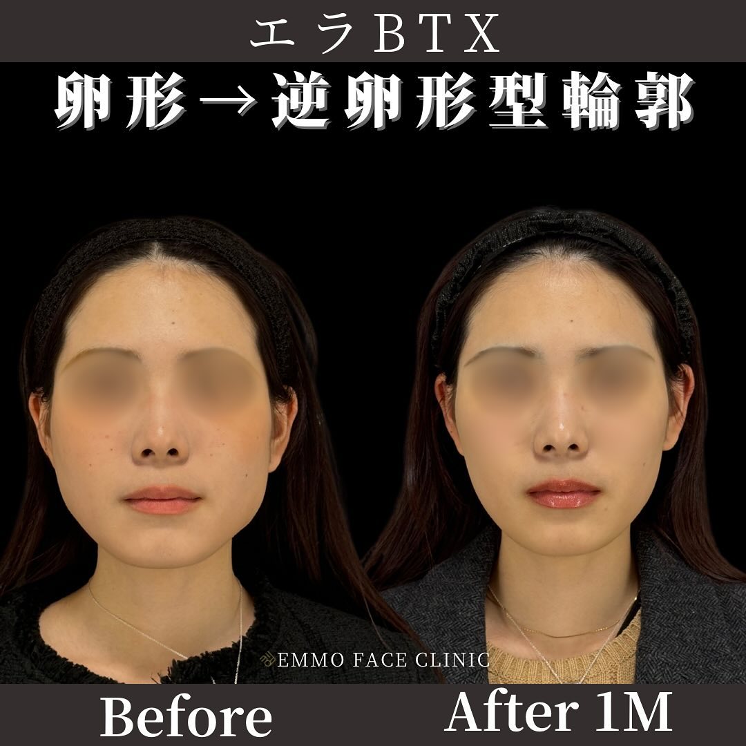 エラボトックス