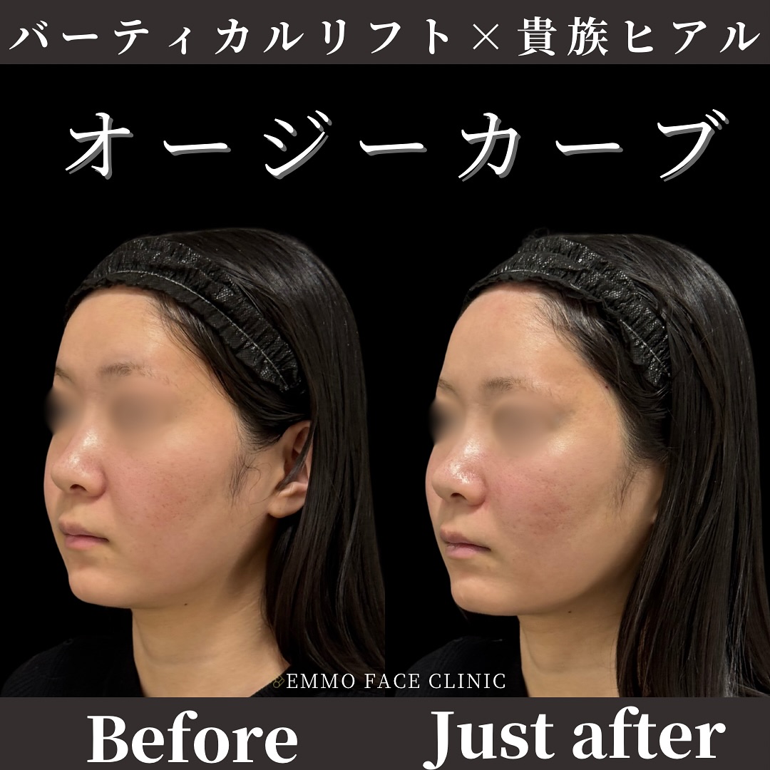 バーティカルリフト×貴族ヒアルロン酸