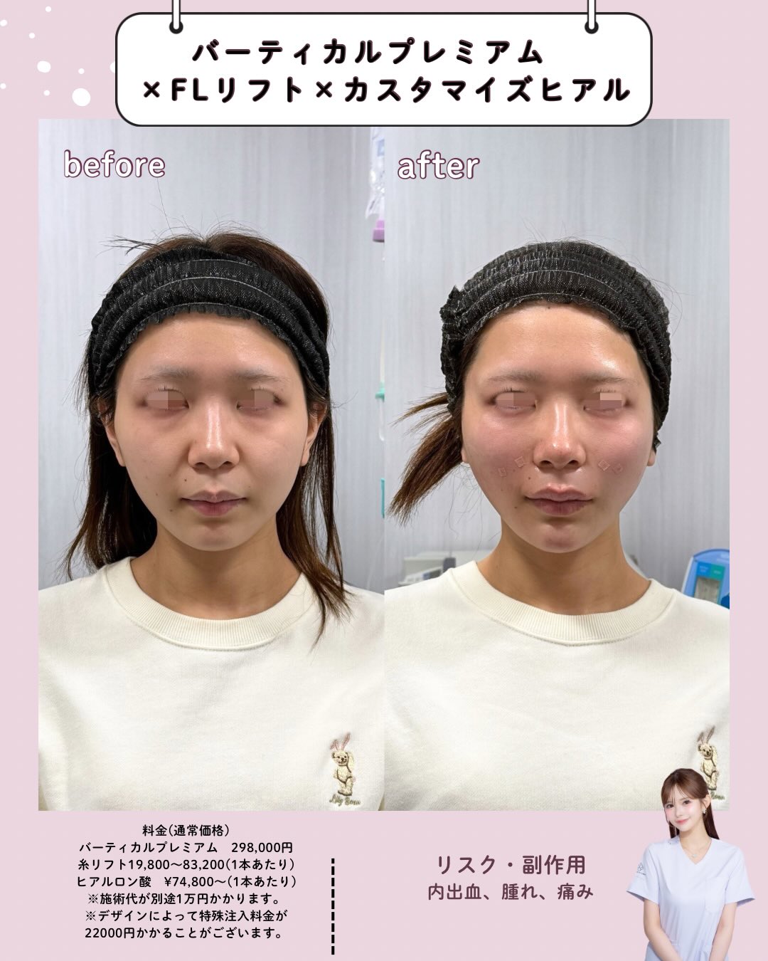 バーティカルリフト×糸リフト×ヒアルロン酸