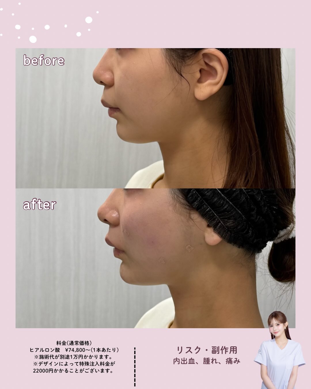 バーティカルリフト×糸リフト×ヒアルロン酸