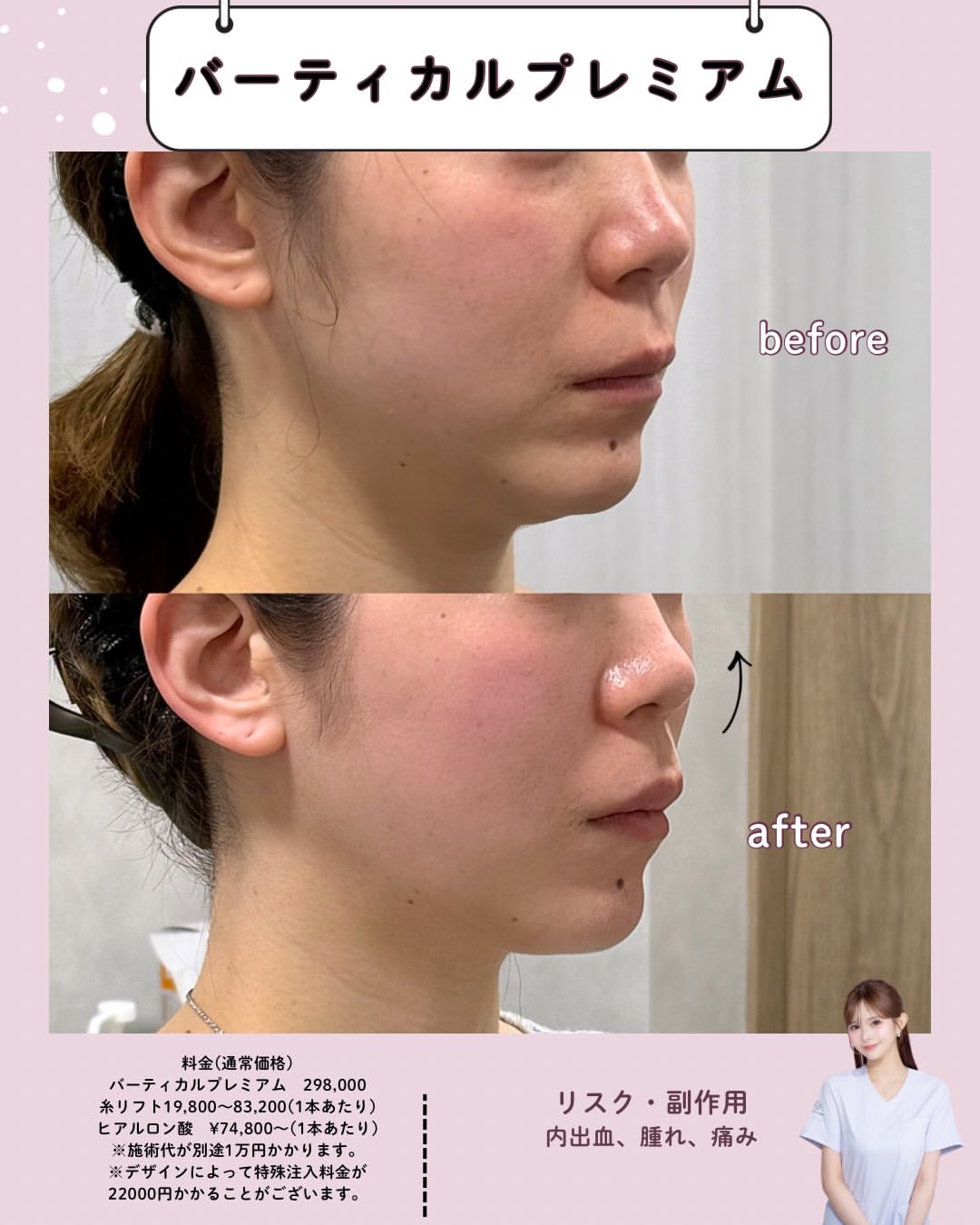 バーティカルリフトプレミアム