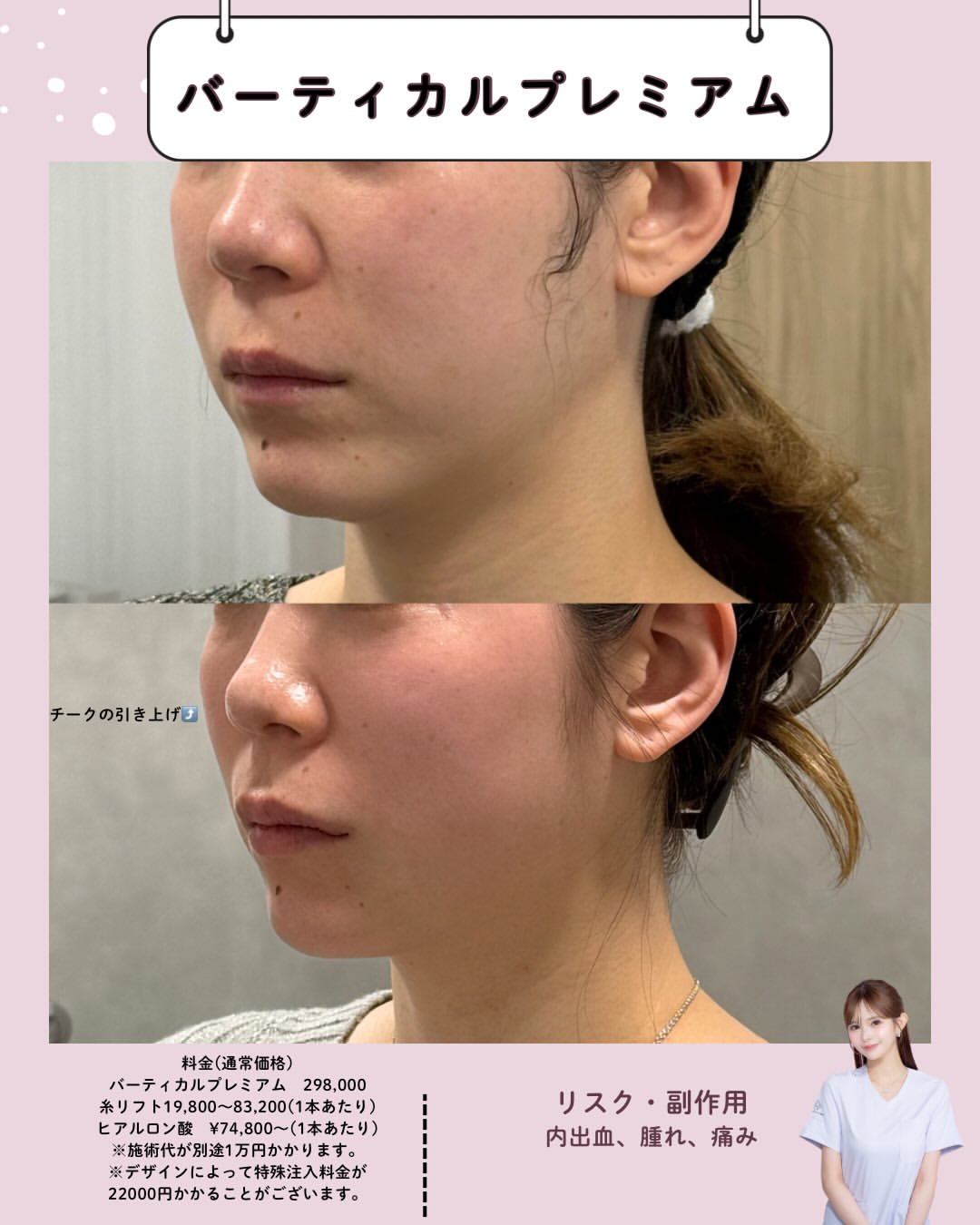 バーティカルリフトプレミアム