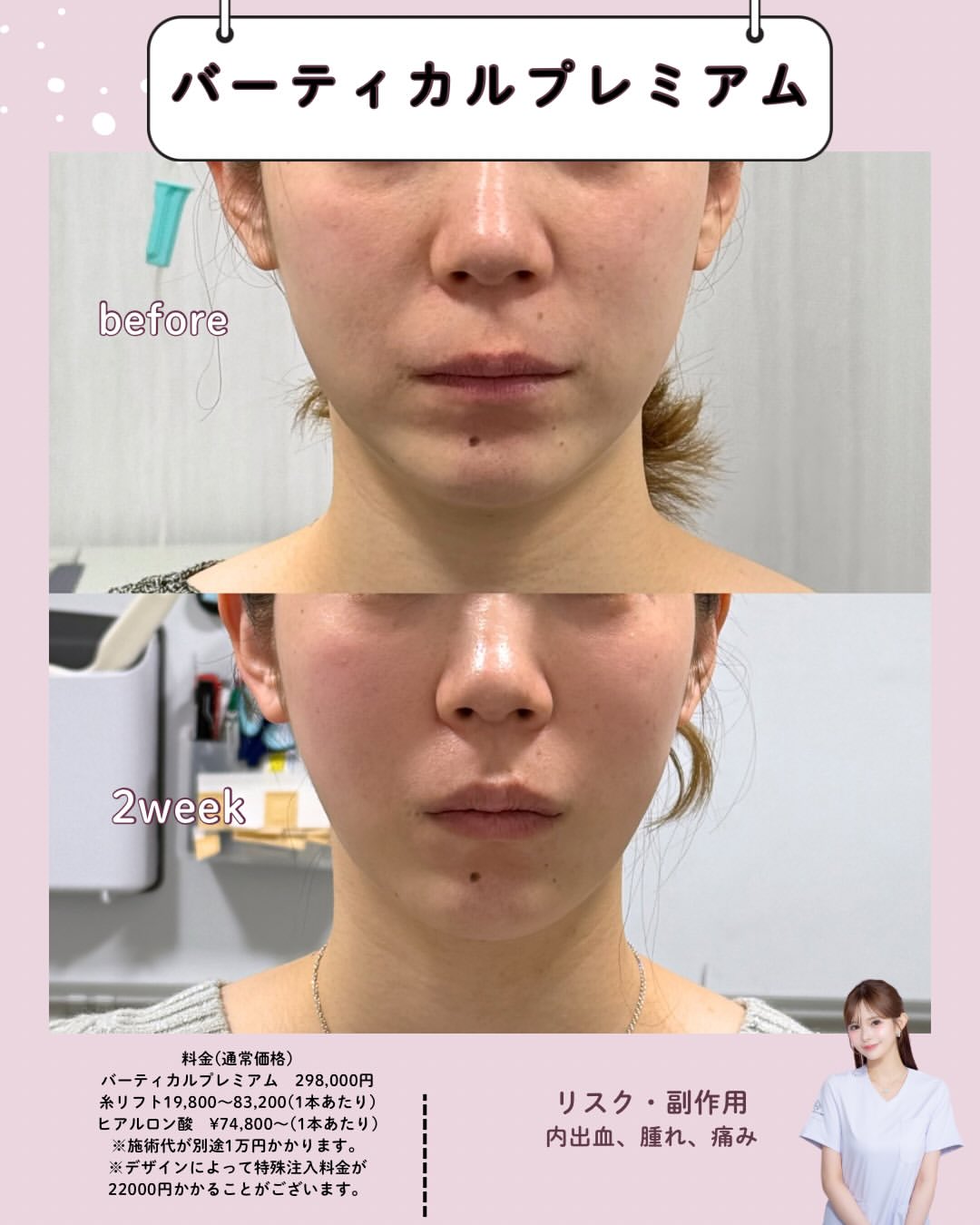 バーティカルリフトプレミアム