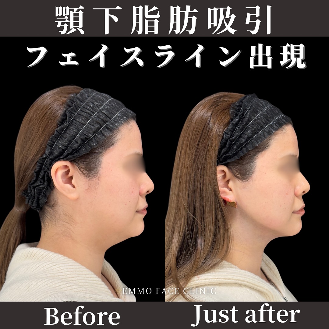 顎下脂肪吸引