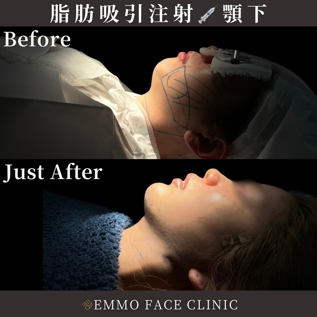 顎下脂肪吸引