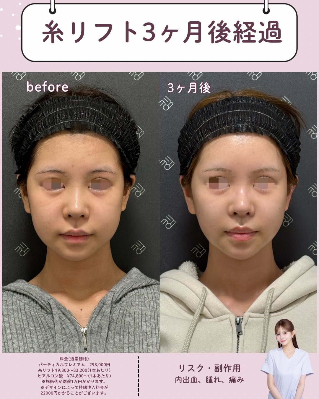 バーティカルリフトプレミアム×糸リフト