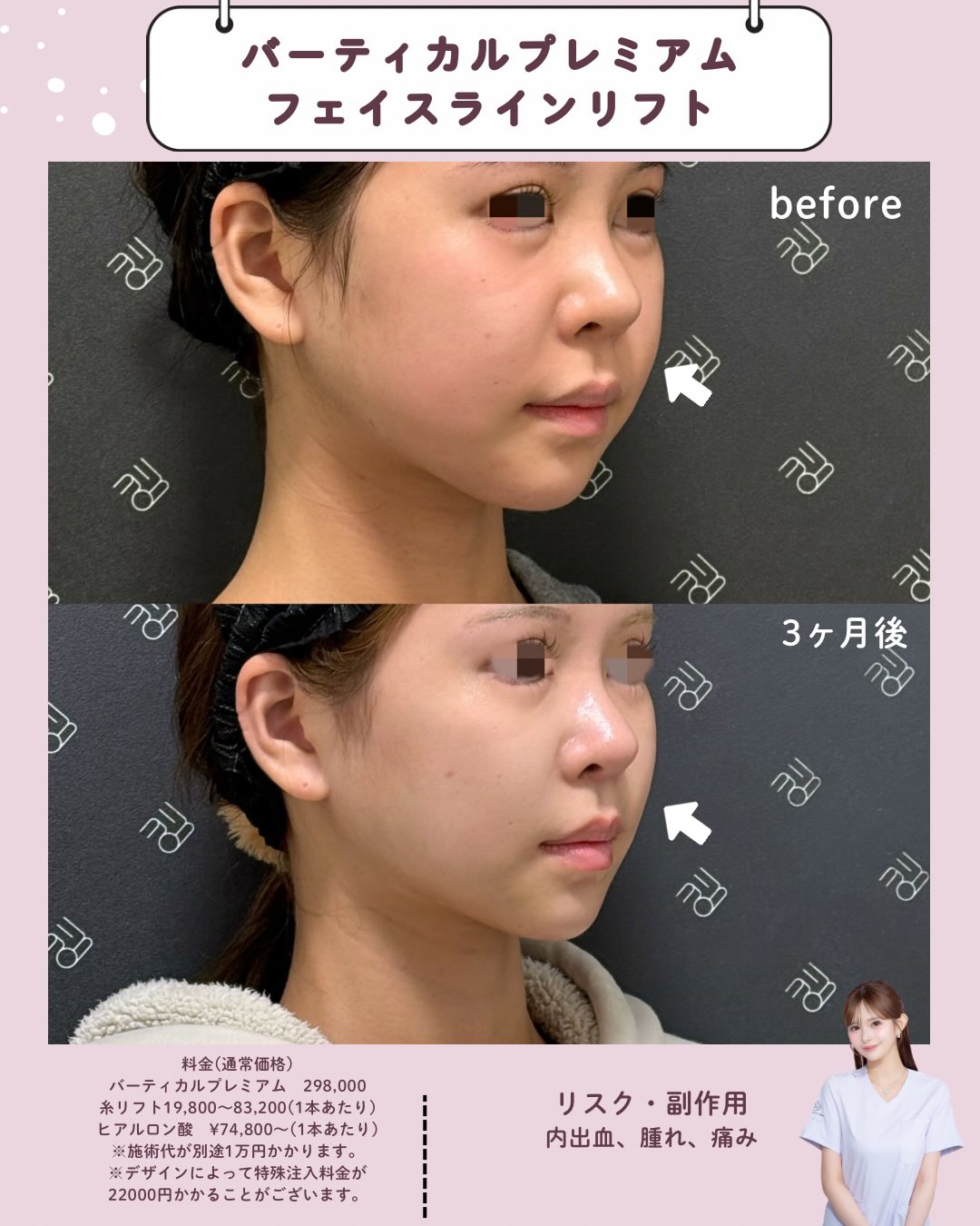 バーティカルリフトプレミアム×糸リフト