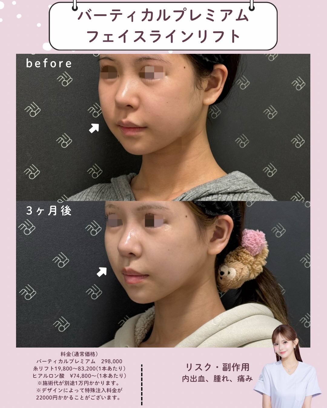 バーティカルリフトプレミアム×糸リフト