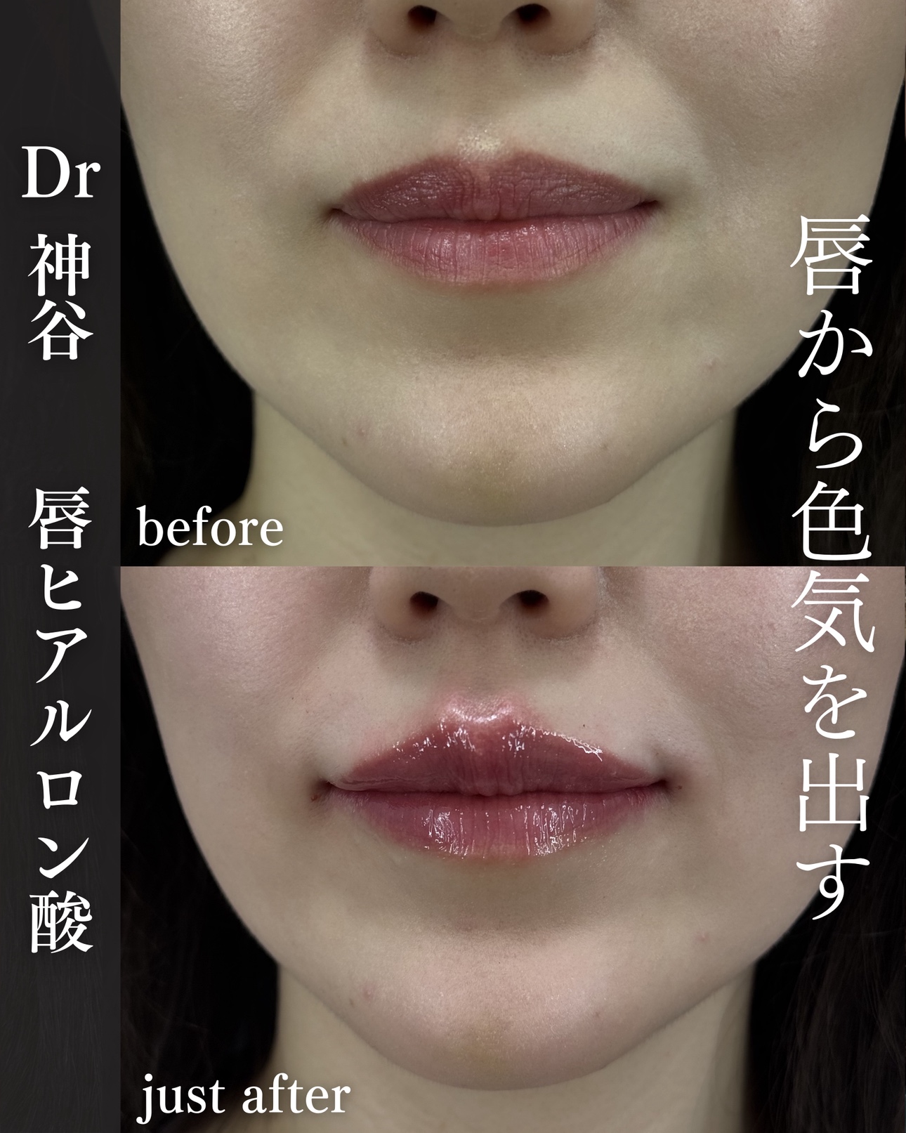 唇ヒアルロン酸ー症例写真