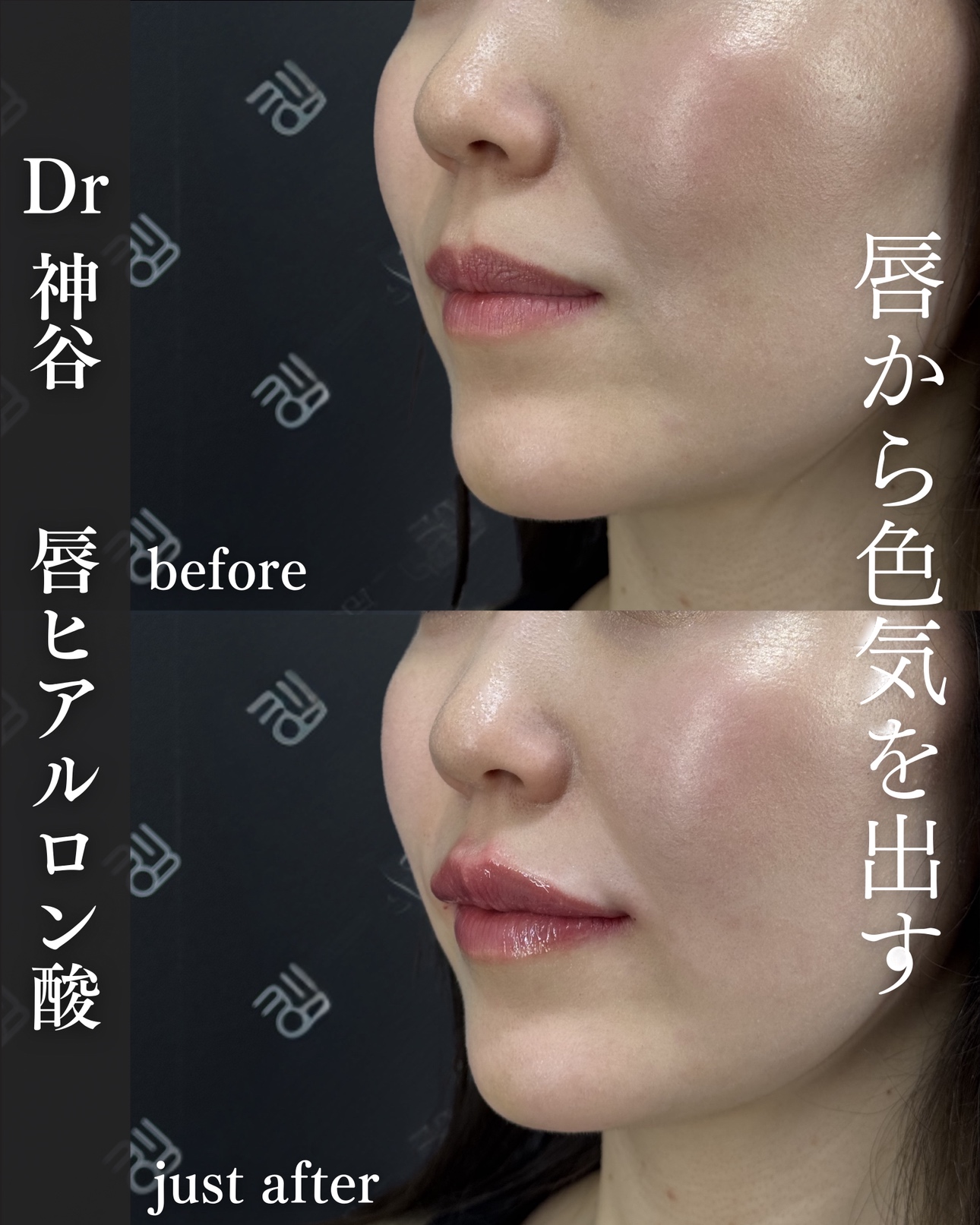 唇ヒアルロン酸ー症例写真