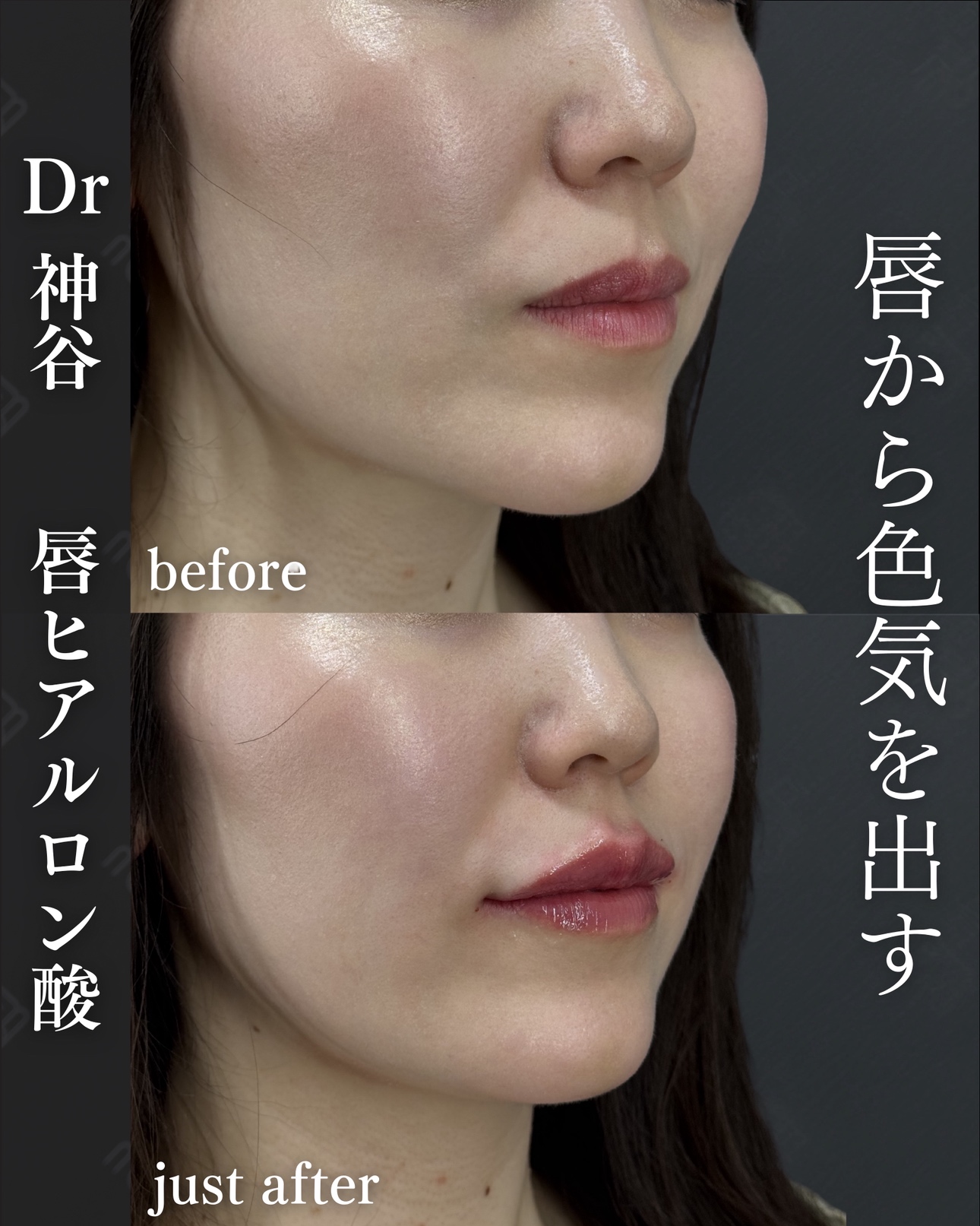 唇ヒアルロン酸ー症例写真