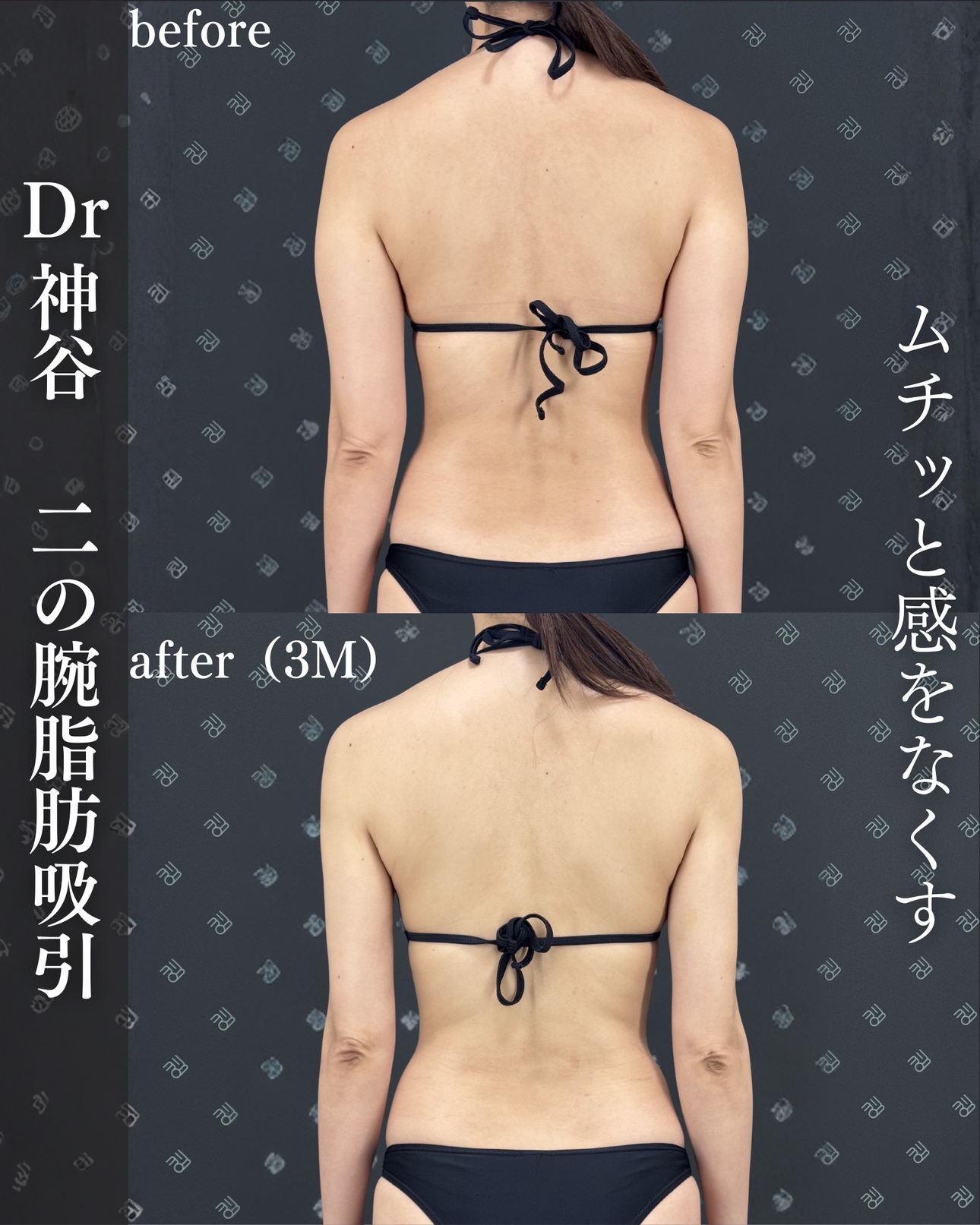 二の腕脂肪吸引ー症例写真