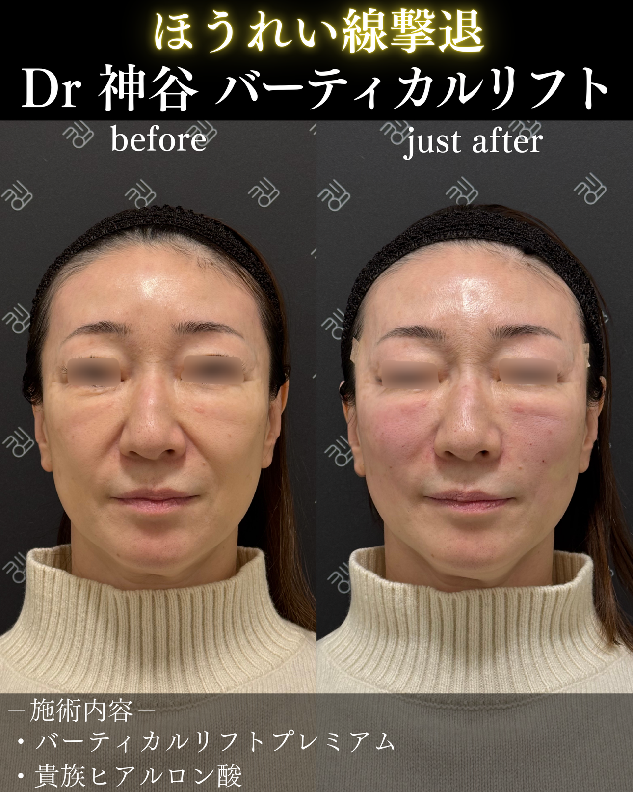 バーティカルリフトー症例写真