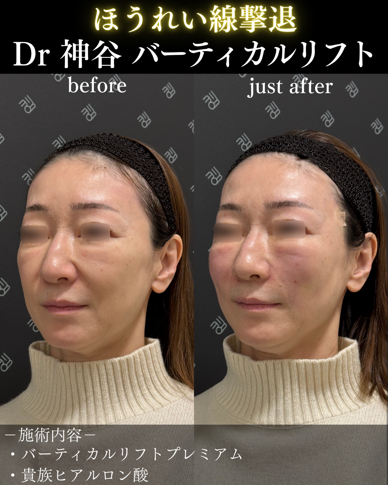 バーティカルリフトー症例写真