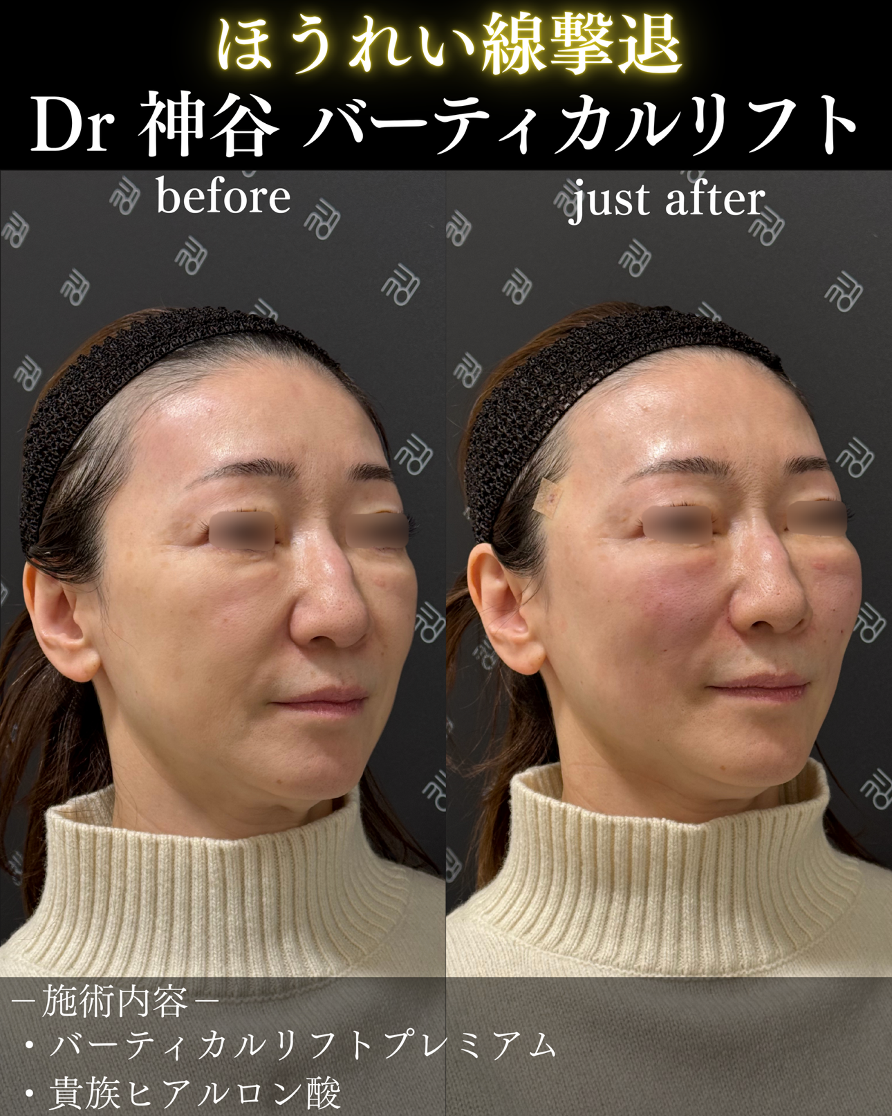 バーティカルリフトー症例写真