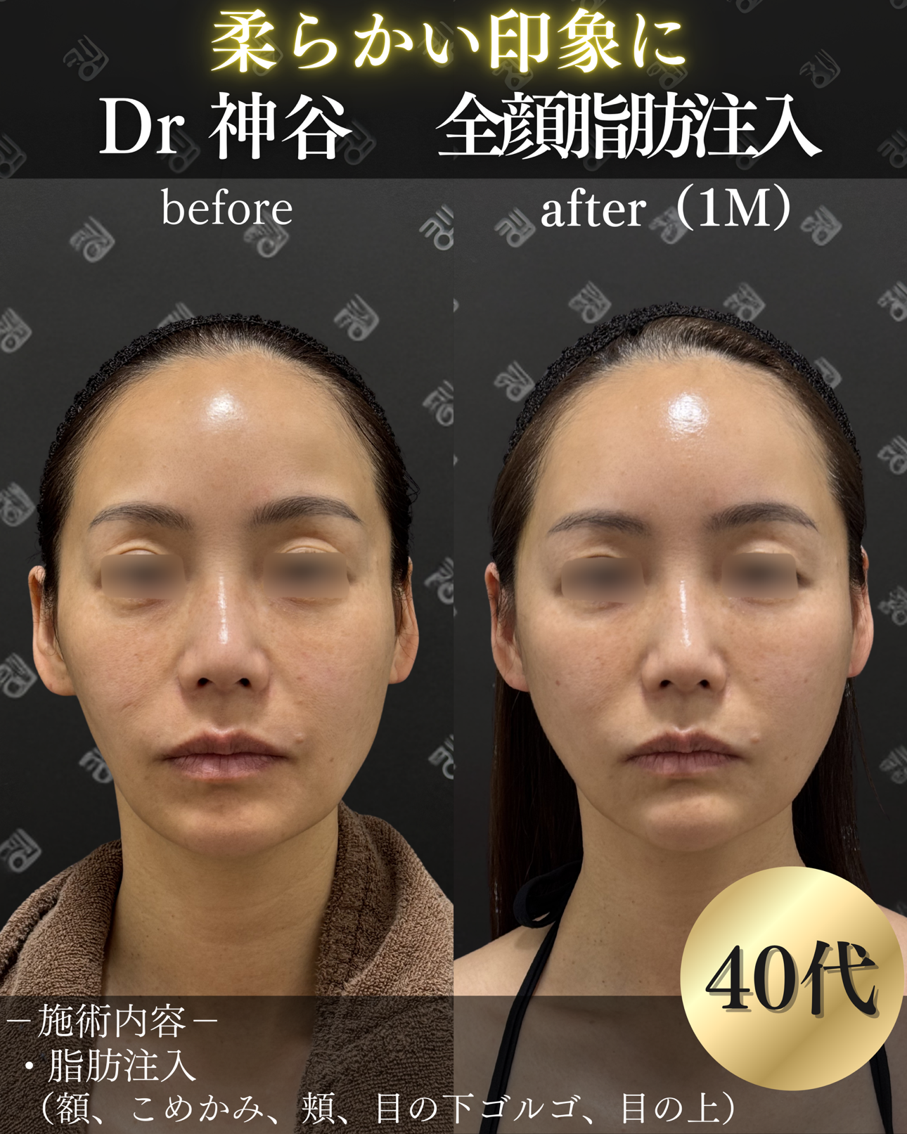 脂肪注入ー症例写真