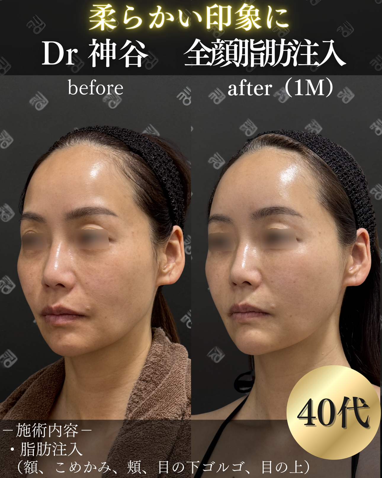 脂肪注入ー症例写真