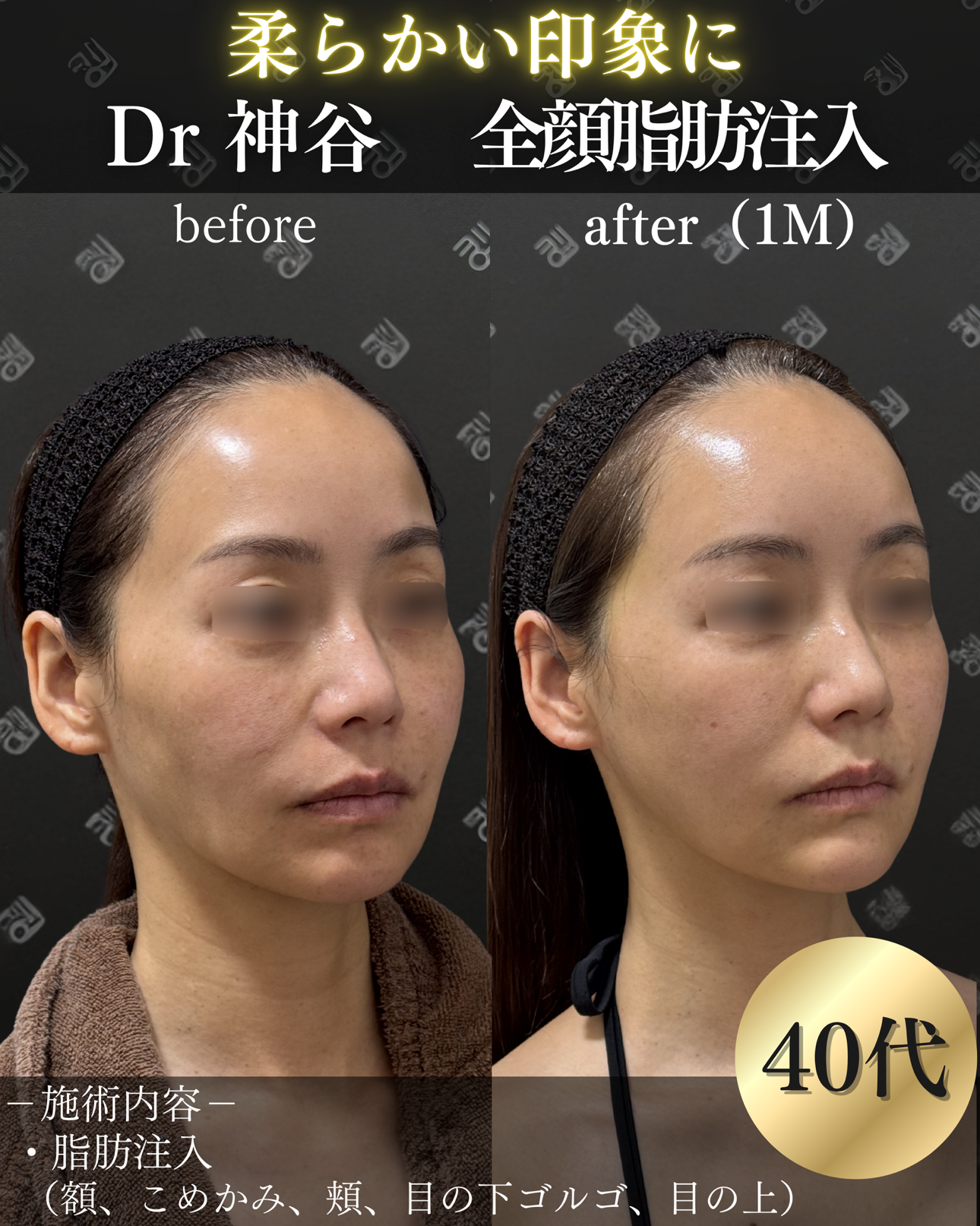 脂肪注入ー症例写真