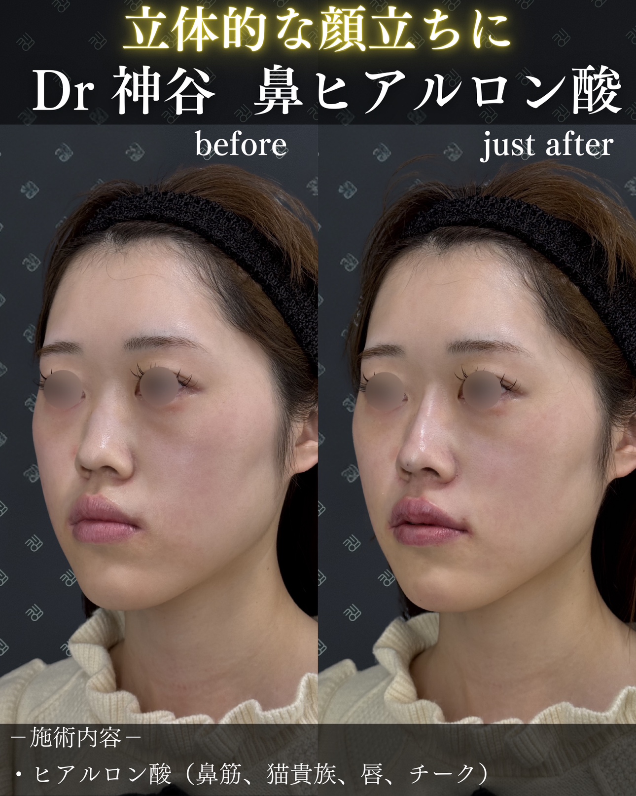 ヒアルロン酸ー症例写真