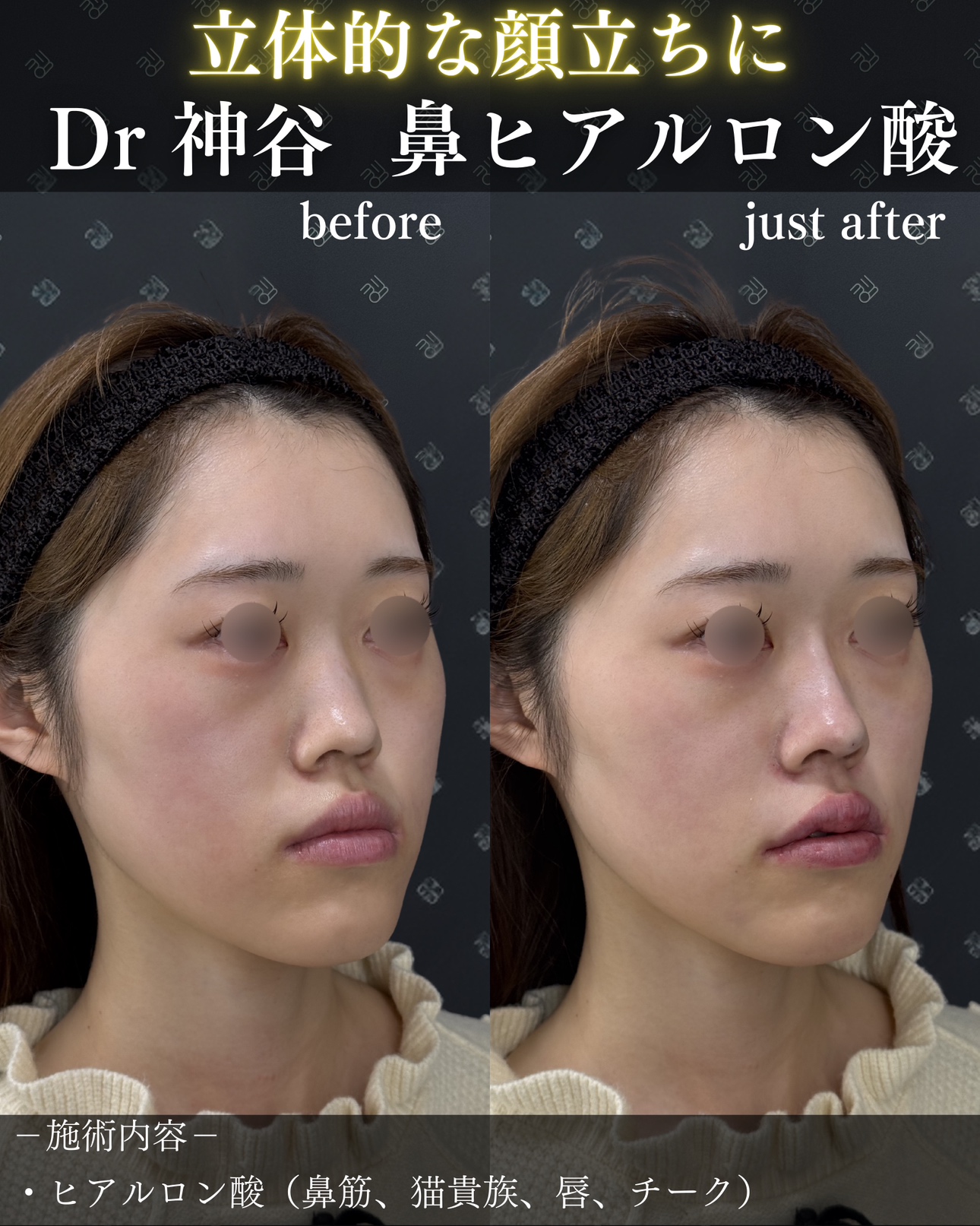 ヒアルロン酸ー症例写真