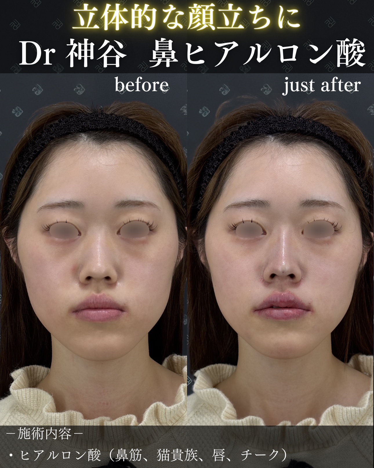 ヒアルロン酸ー症例写真