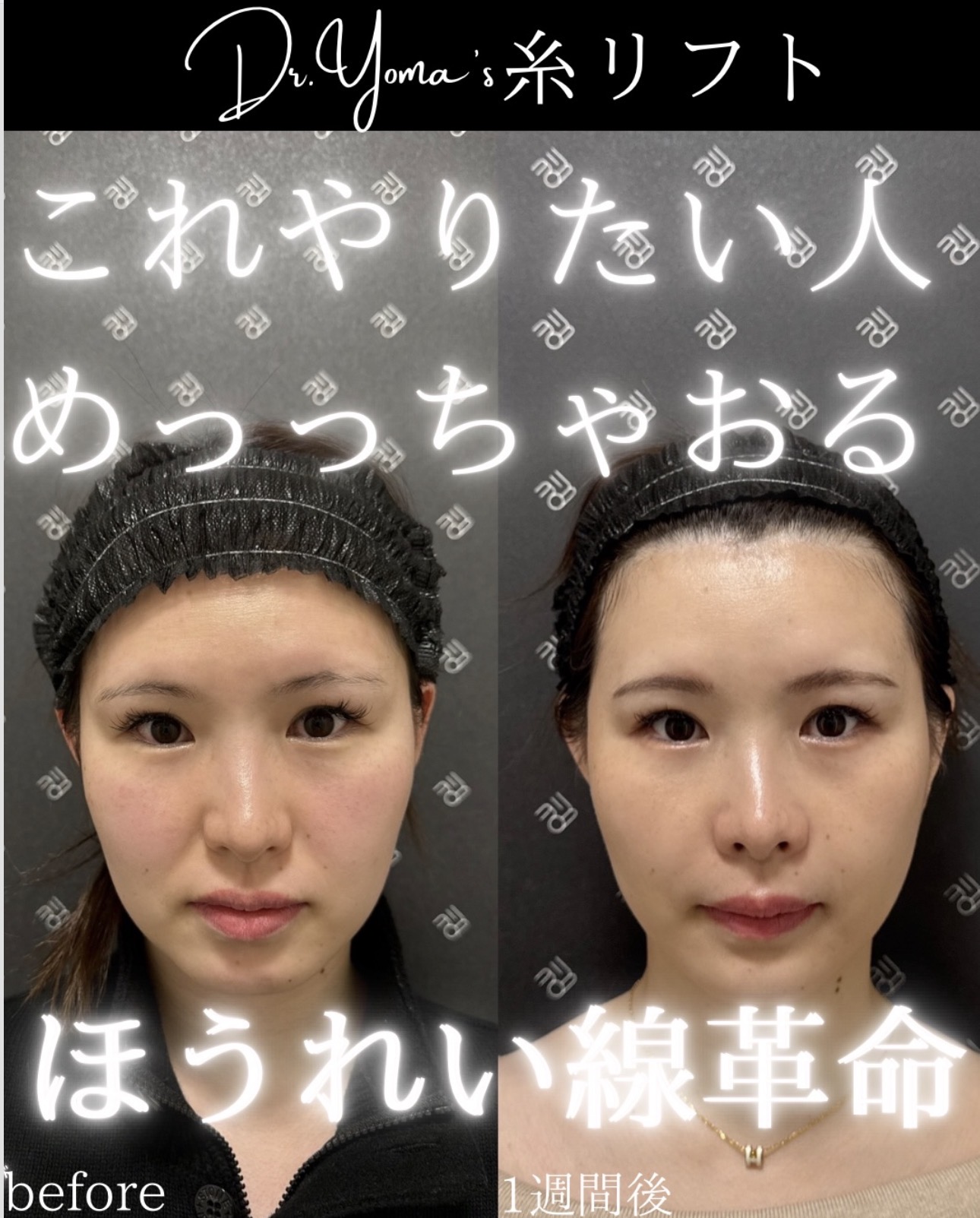 バーティカルリフト