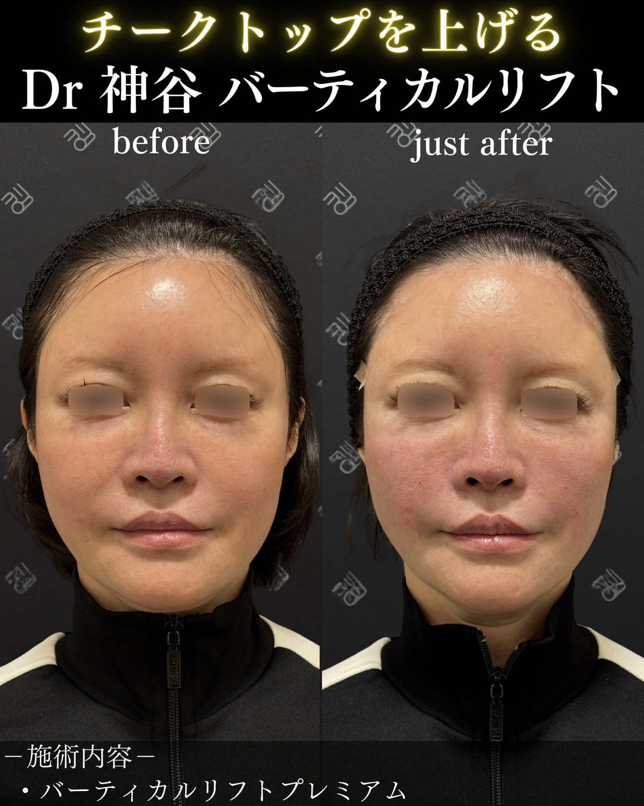 バーティカルリフトー症例写真