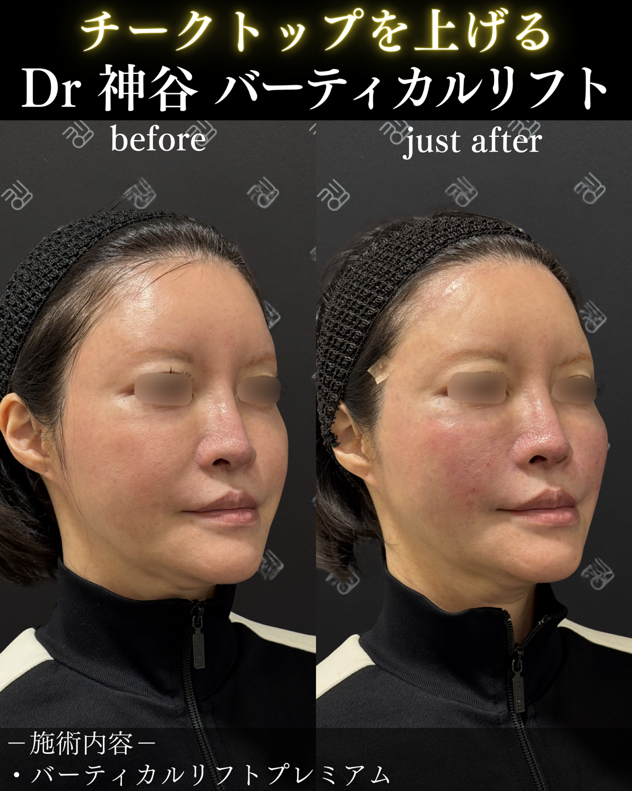 バーティカルリフトー症例写真