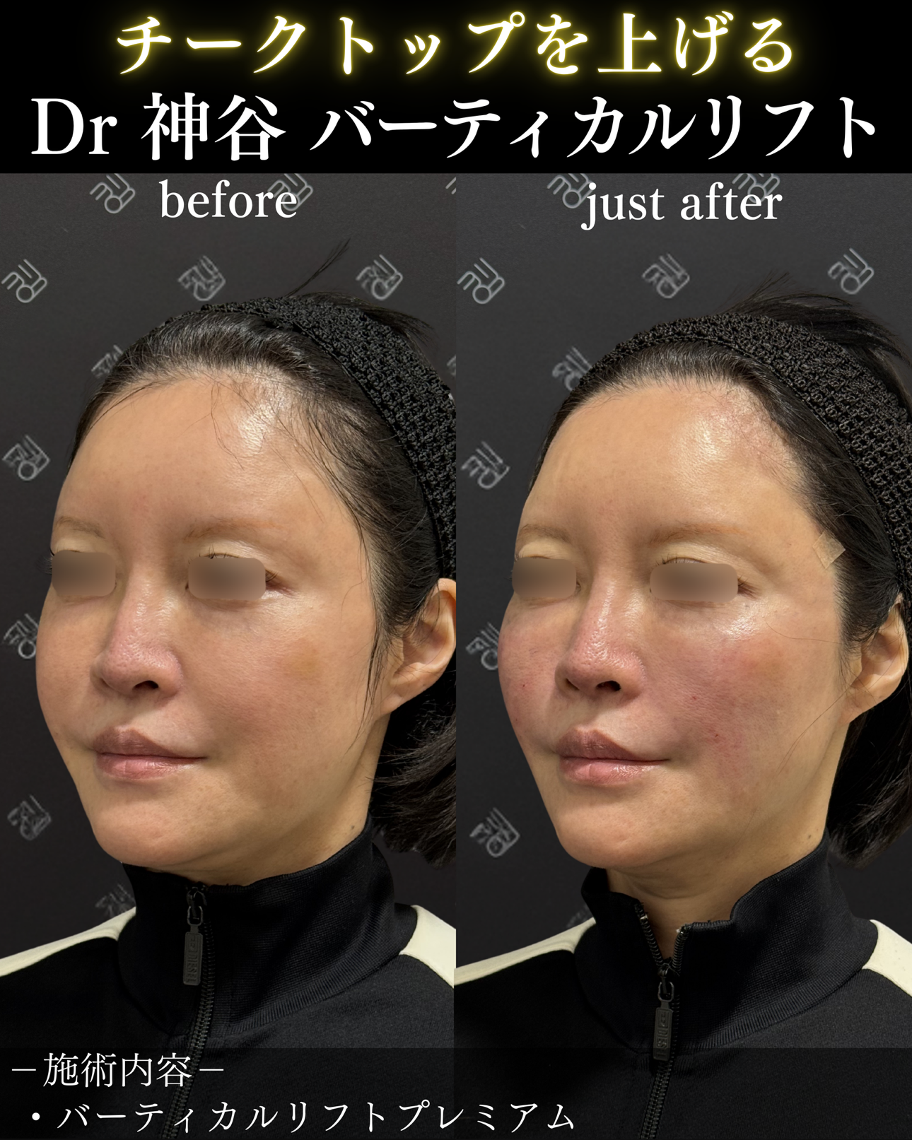 バーティカルリフトー症例写真