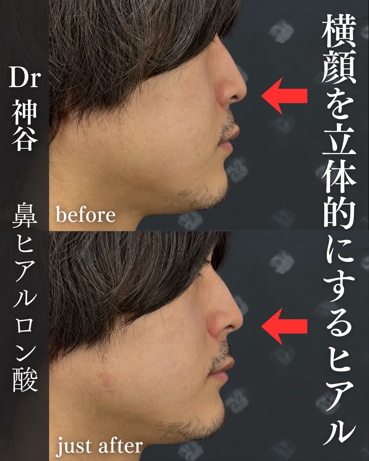 ヒアルロン酸ー症例写真