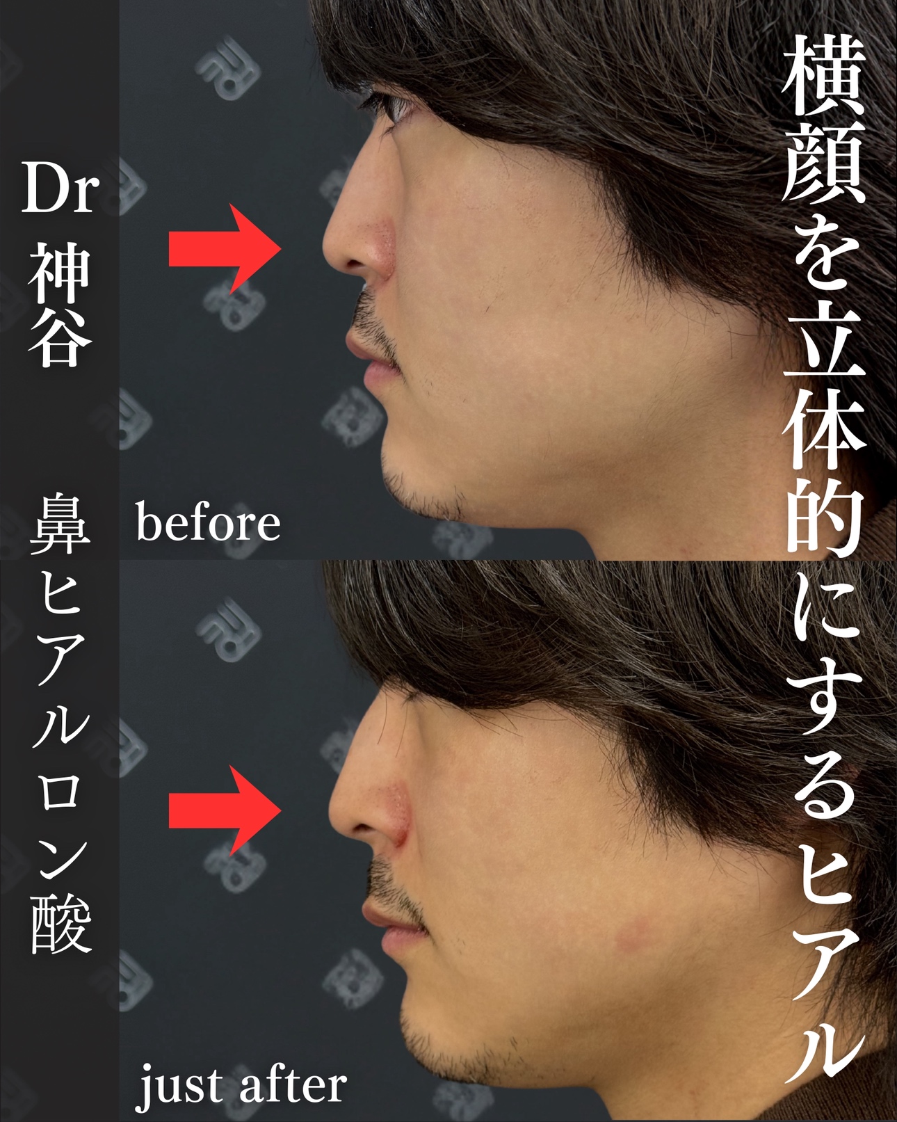 ヒアルロン酸ー症例写真