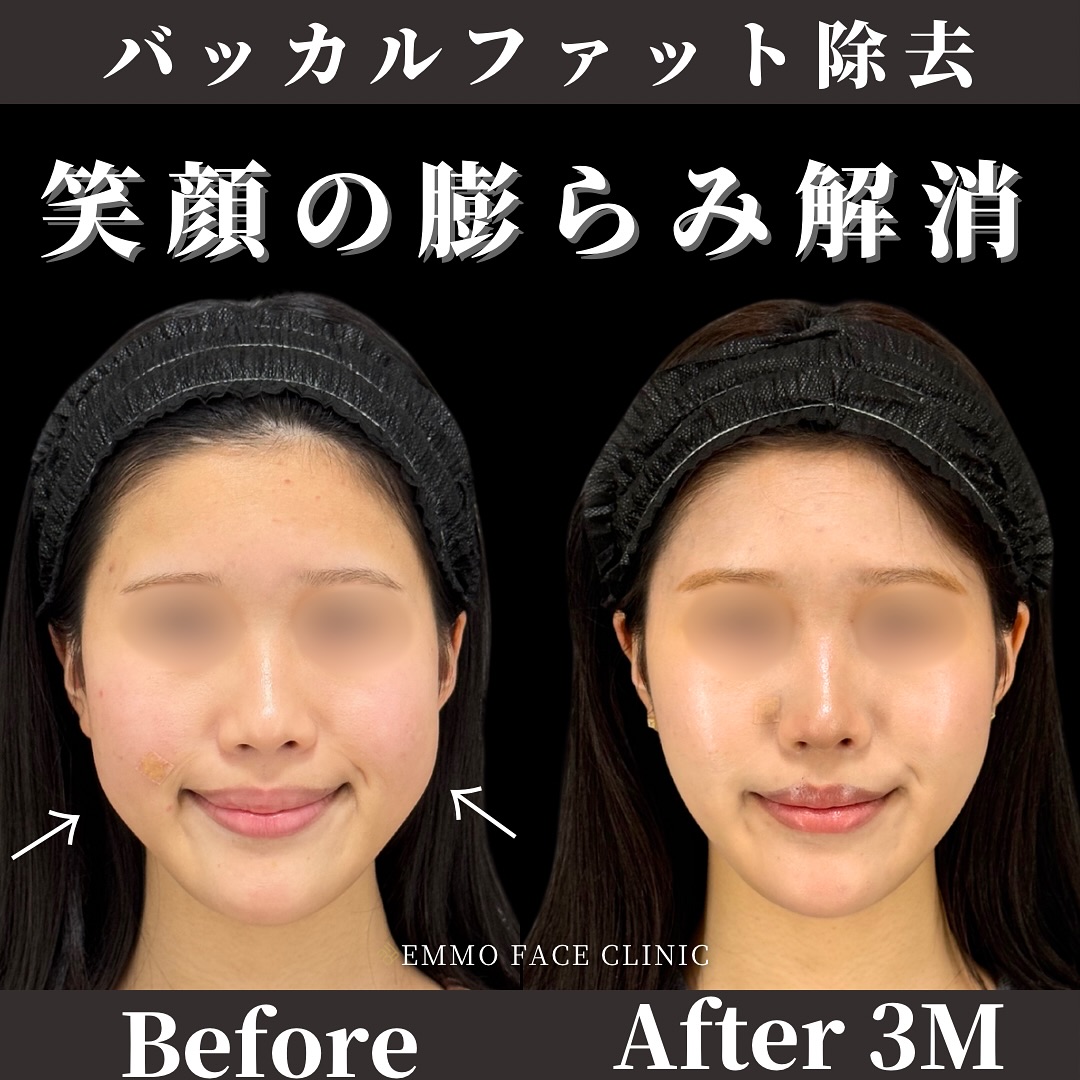 バッカルファット除去