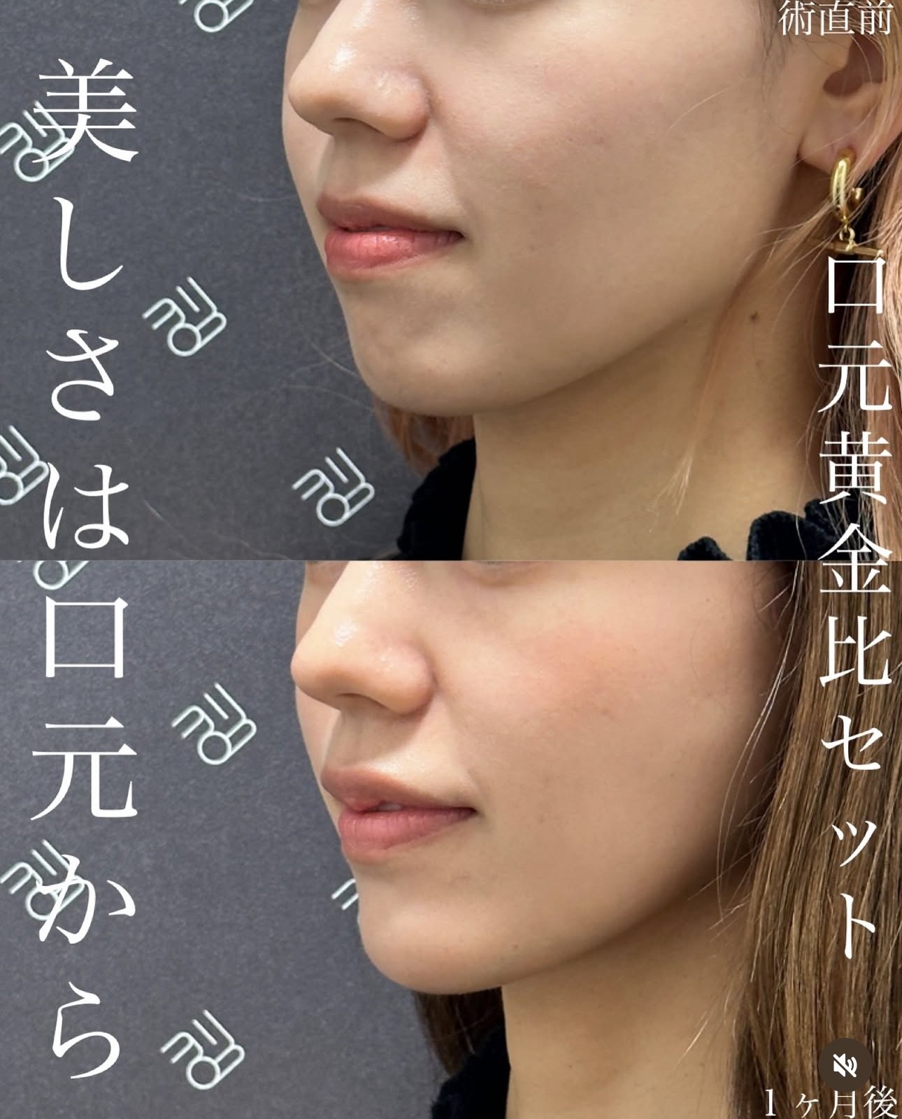 口元黄金比セットのビフォーアフター