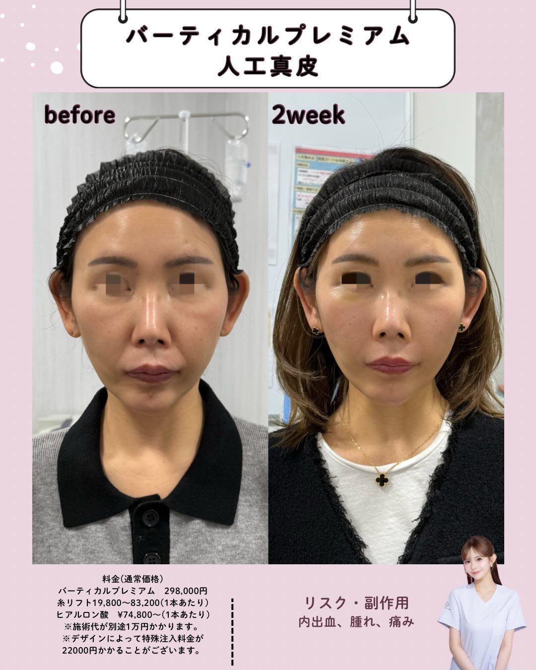 バーティカルリフト×人工真皮