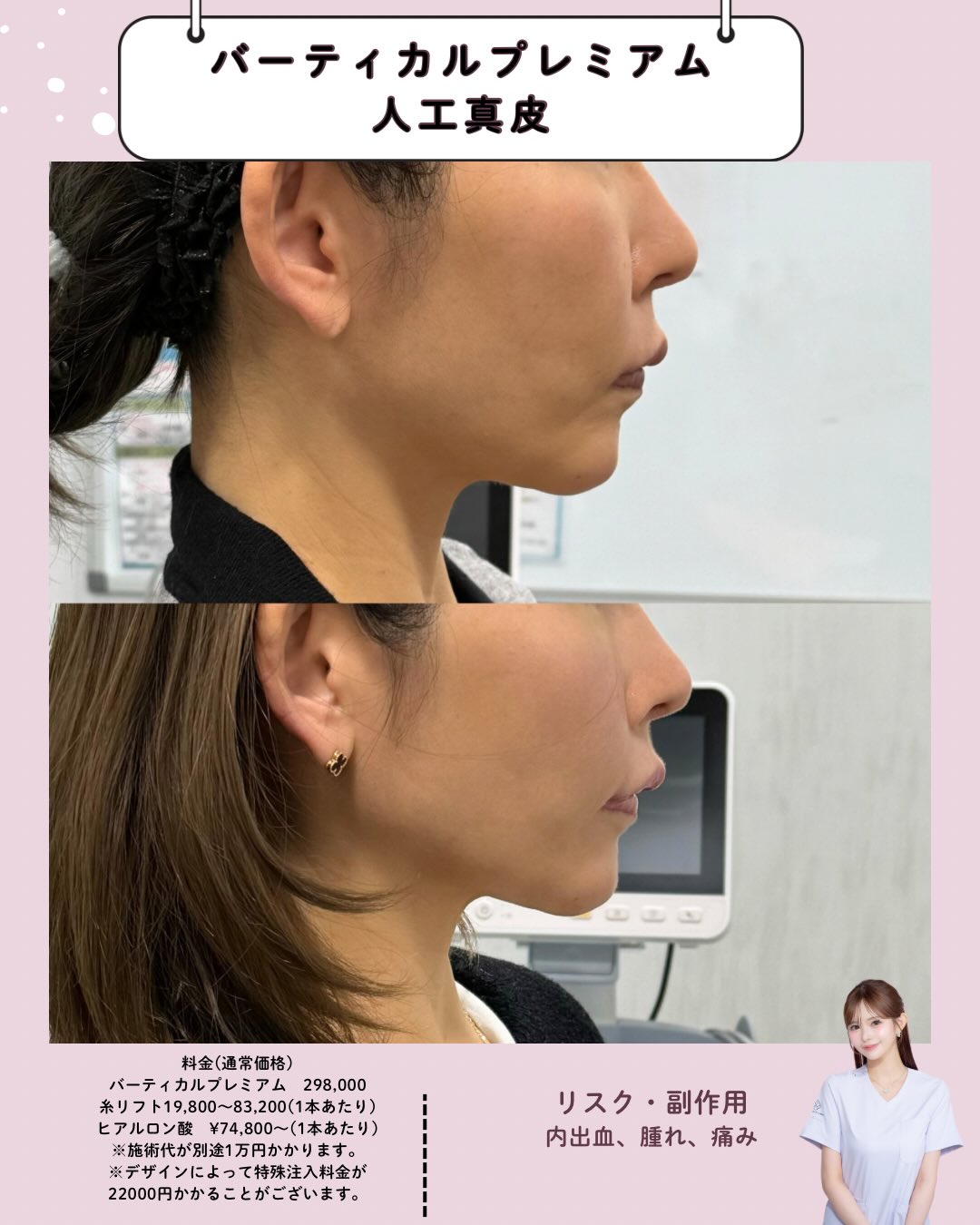 バーティカルリフト×人工真皮