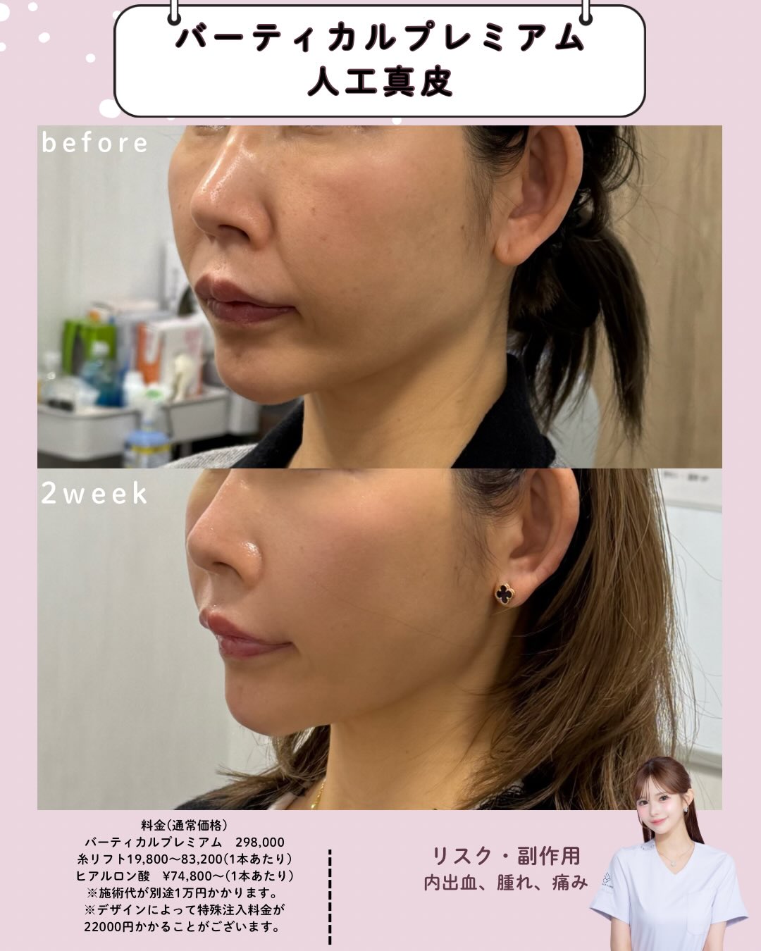 バーティカルリフト×人工真皮