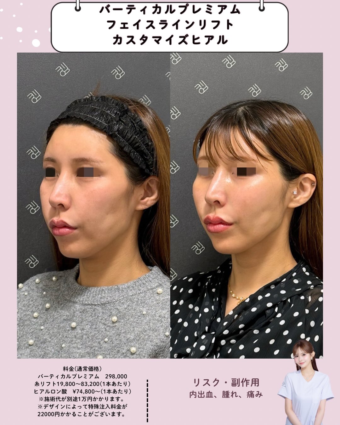 バーティカルリフトプレミアム×糸リフト×カスタマイズヒアルロン酸